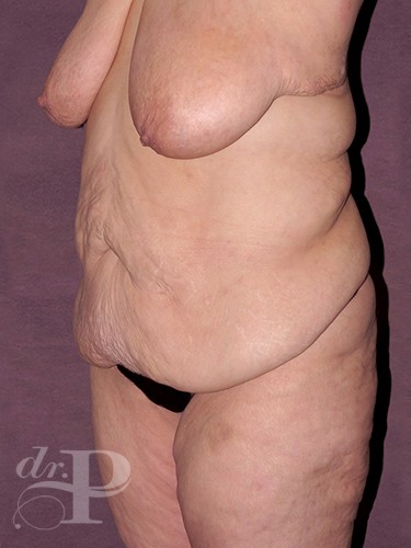 Case--29091 | Before True Form Tummy Tuck® in Overweight & Weight Loss Patients 2