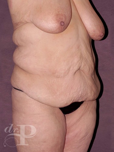 Case--29091 | Before True Form Tummy Tuck® in Overweight & Weight Loss Patients 5