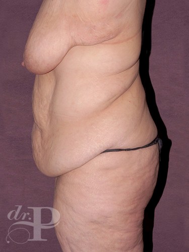 Case--29112 | Before Lower Body Lift (Buttock Lift) 3