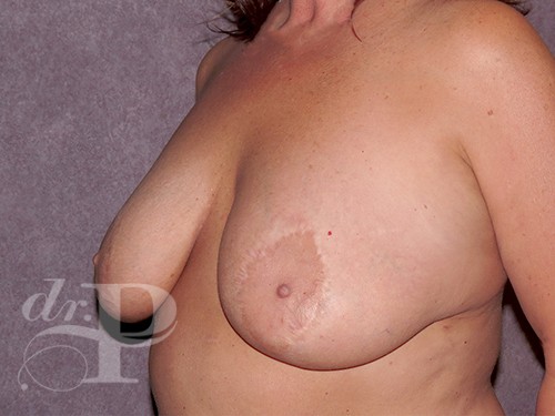 Case--28429 | Before Breast Lift 2
