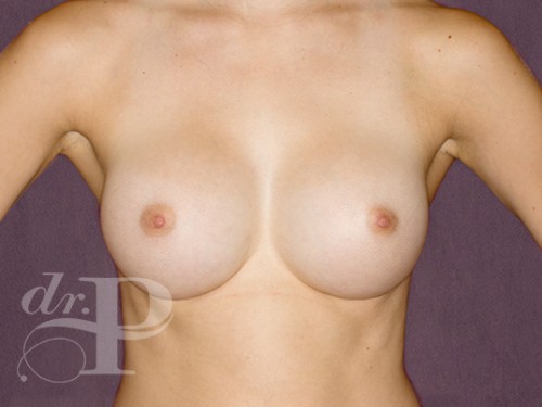 Case--28840 | After Breast Augmentation 1