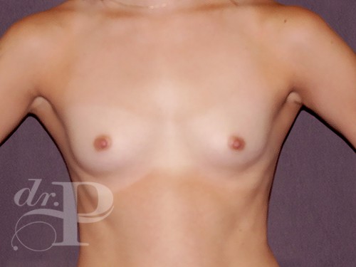 Case--28840 | Before Breast Augmentation 1