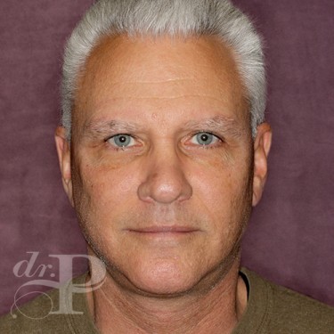 Case--28577 | After Eyelid Surgery (Blepharoplasty) 1