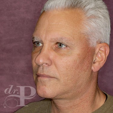 Case--28577 | After Eyelid Surgery (Blepharoplasty) 2