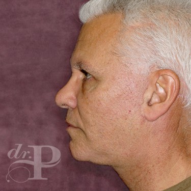 Case--28591 | After Facelift and Neck Lift 3