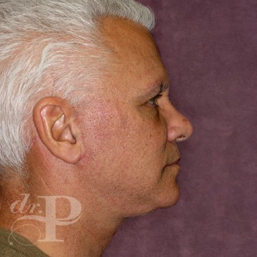 Case--28591 | After Facelift and Neck Lift 5