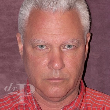Case--28577 | Before Eyelid Surgery (Blepharoplasty) 1