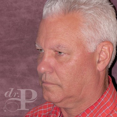 Case--28577 | Before Eyelid Surgery (Blepharoplasty) 2