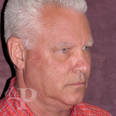 Case--28591 | Before Facelift and Neck Lift 4