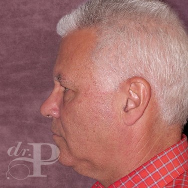 Case--28577 | Before Eyelid Surgery (Blepharoplasty) 3