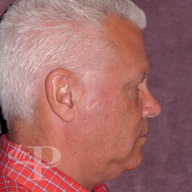 Case--28577 | Before Eyelid Surgery (Blepharoplasty) 5