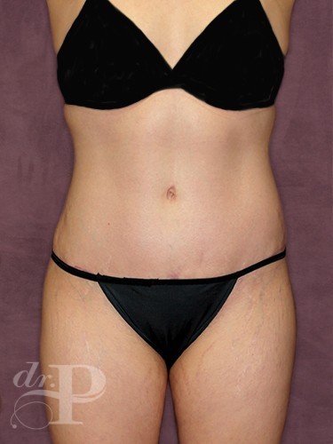 Case--1096 | After Liposuction 1