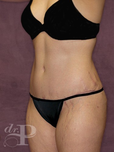 Case--1086 | After Liposuction 2