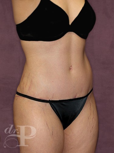 Case--1096 | After Liposuction 3