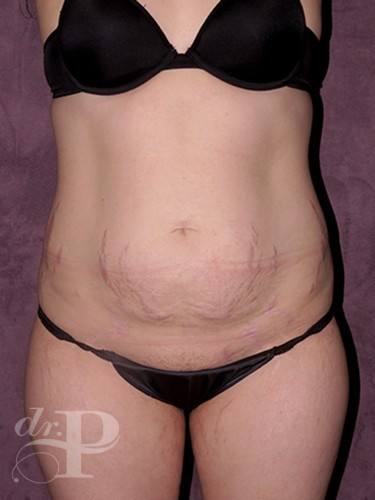 Case--1096 | Before Liposuction 1