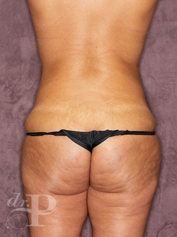 Case--1245 | Before True Form Tummy Tuck® 4