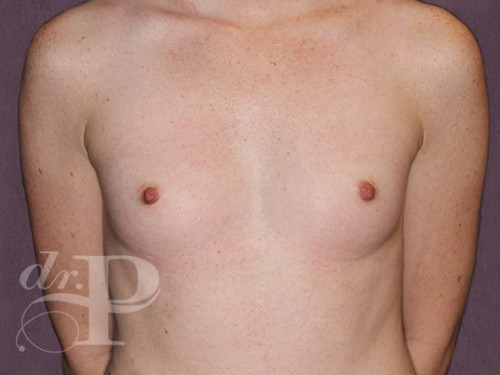 Case--29082 | Before Breast Augmentation 1