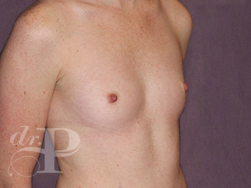 Case--29082 | Before Breast Augmentation 3
