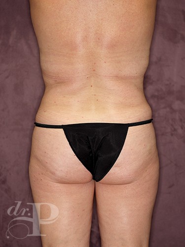 Case--432 | After Liposuction 4
