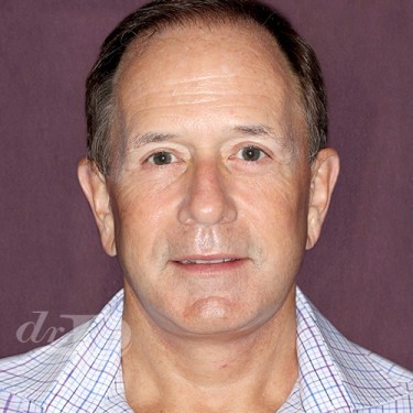 Case--28879 | After Facelift and Neck Lift 1