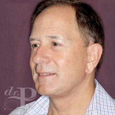 Case--28879 | After Facelift and Neck Lift 2