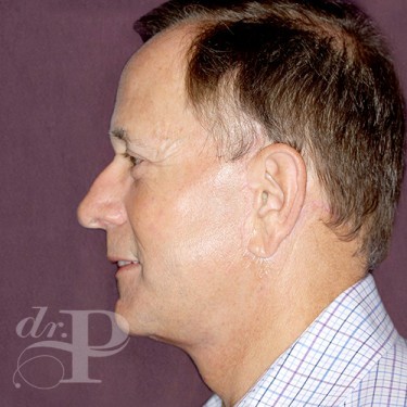 Case--28879 | After Facelift and Neck Lift 3