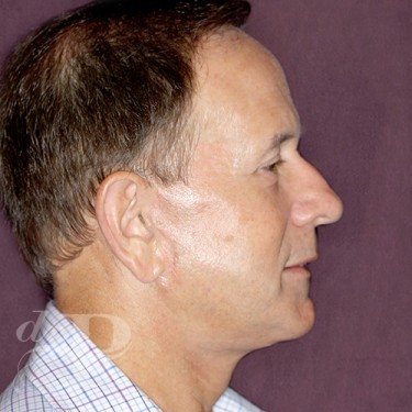 Case--28856 | After Eyelid Lift for Men 5