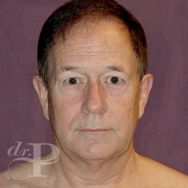 Case--28879 | Before Facelift and Neck Lift 1