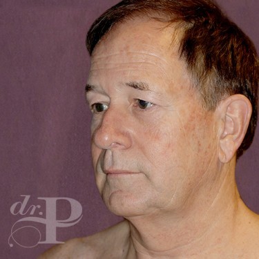 Case--28879 | Before Facelift and Neck Lift 2