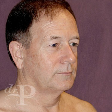 Case--28879 | Before Facelift and Neck Lift 4