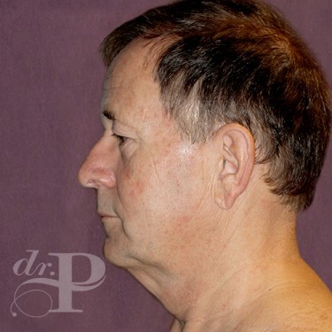 Case--28879 | Before Facelift and Neck Lift 3