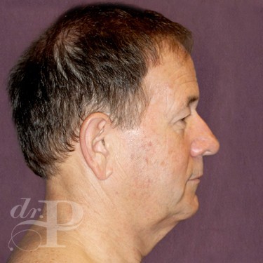 Case--28879 | Before Facelift and Neck Lift 5