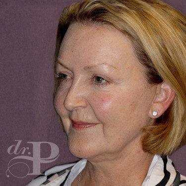 Case--28654 | Before Eyelid Surgery (Blepharoplasty) 2