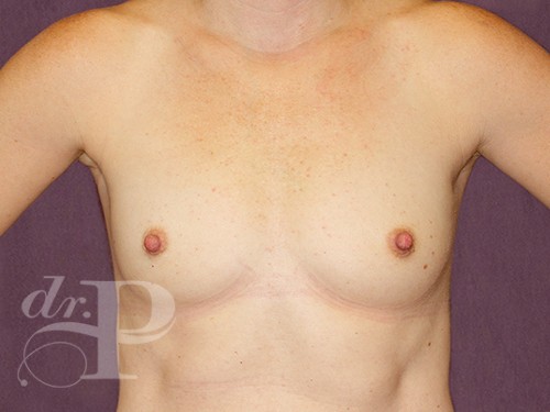 Case--28717 | Before Breast Augmentation 1