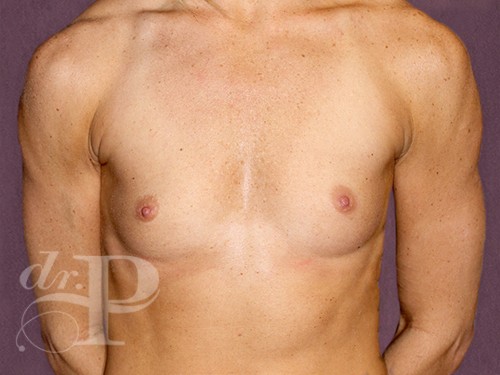 Case--29115 | Before Breast Augmentation 1