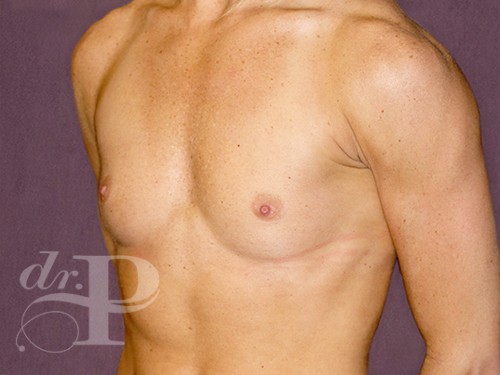 Case--29115 | Before Breast Augmentation 2