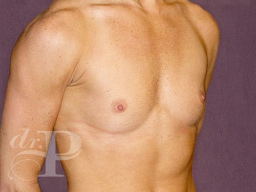 Case--29115 | Before Breast Augmentation 3