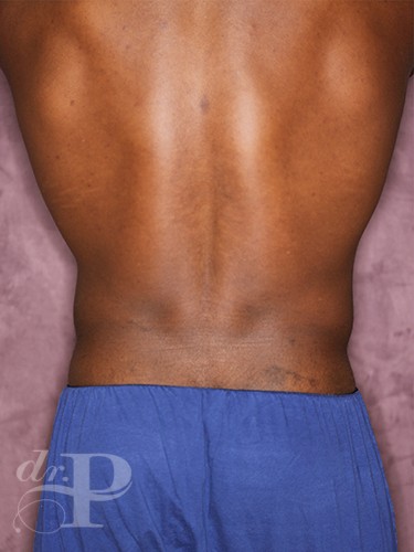 Case--1259 | After Liposuction for Men 4