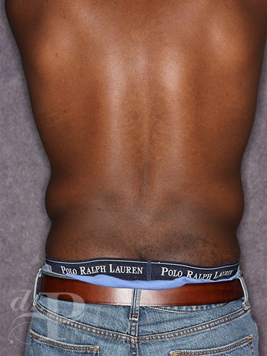 Case--1259 | Before Liposuction for Men 4