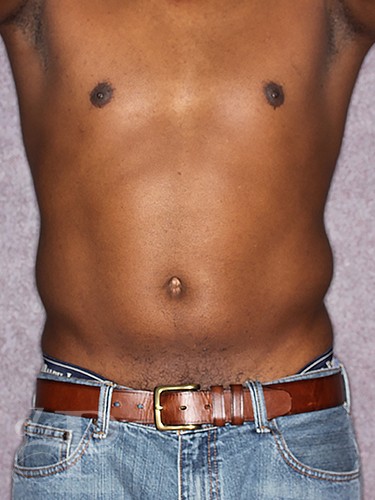 Case--1259 | Before Liposuction for Men 1