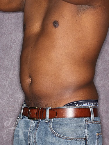 Case--1259 | Before Liposuction for Men 2