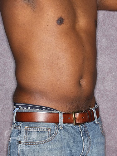 Case--1259 | Before Liposuction for Men 5
