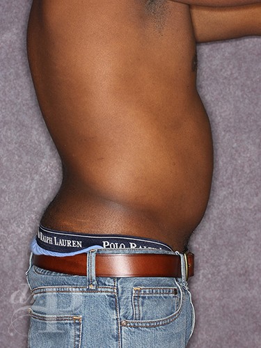 Case--1259 | Before Liposuction for Men 6