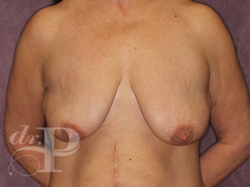 Case--28437 | Before Breast Augmentation and Breast Lift 1