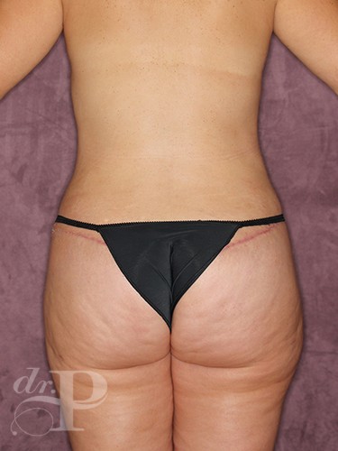 Case--275 | After True Form Tummy Tuck® 4