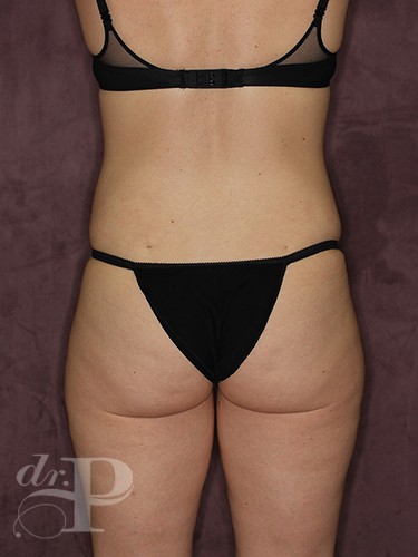 Case--462 | After Liposuction 4