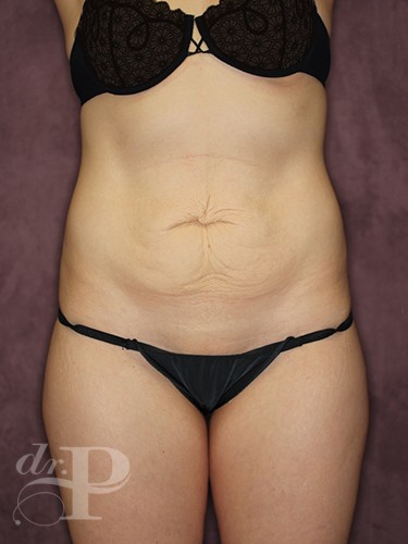 Case--462 | Before Liposuction 1