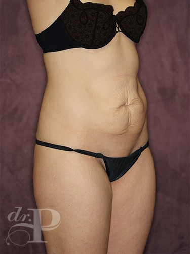 Case--462 | Before Liposuction 5
