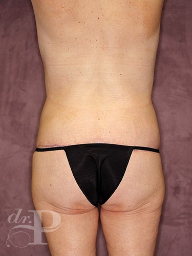 Case--28538 | After True Form Tummy Tuck® in Overweight & Weight Loss Patients 4