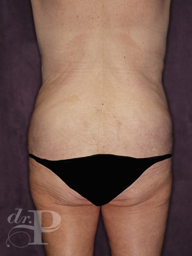 Case--28538 | Before True Form Tummy Tuck® in Overweight & Weight Loss Patients 4